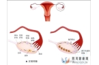 多囊卵巢综合症能做试管婴儿吗？成功率多少(38