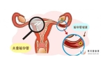 输卵管堵塞做试管婴儿会引起宫外孕吗？不要再听信