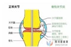 干细胞移植有效治疗膝骨关节炎！