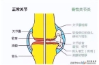 中科西部细胞：干细胞移植有效治疗膝骨关节炎！