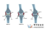 中科西部细胞：干细胞膝关节注射